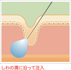 しわの溝に沿って注入