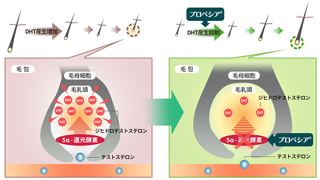 プロペシア