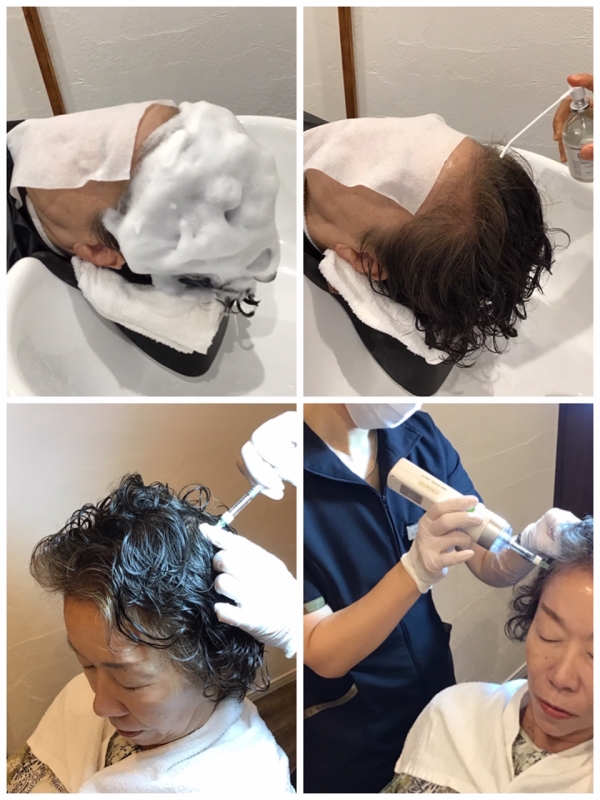 髪のお悩みの救世主‼ヘアフィラー注射　毛髪再生治療（育毛注入治療）