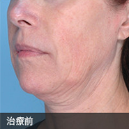治療前